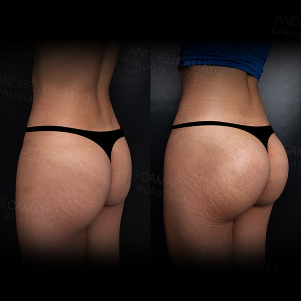 GLUTEOPLASTIA