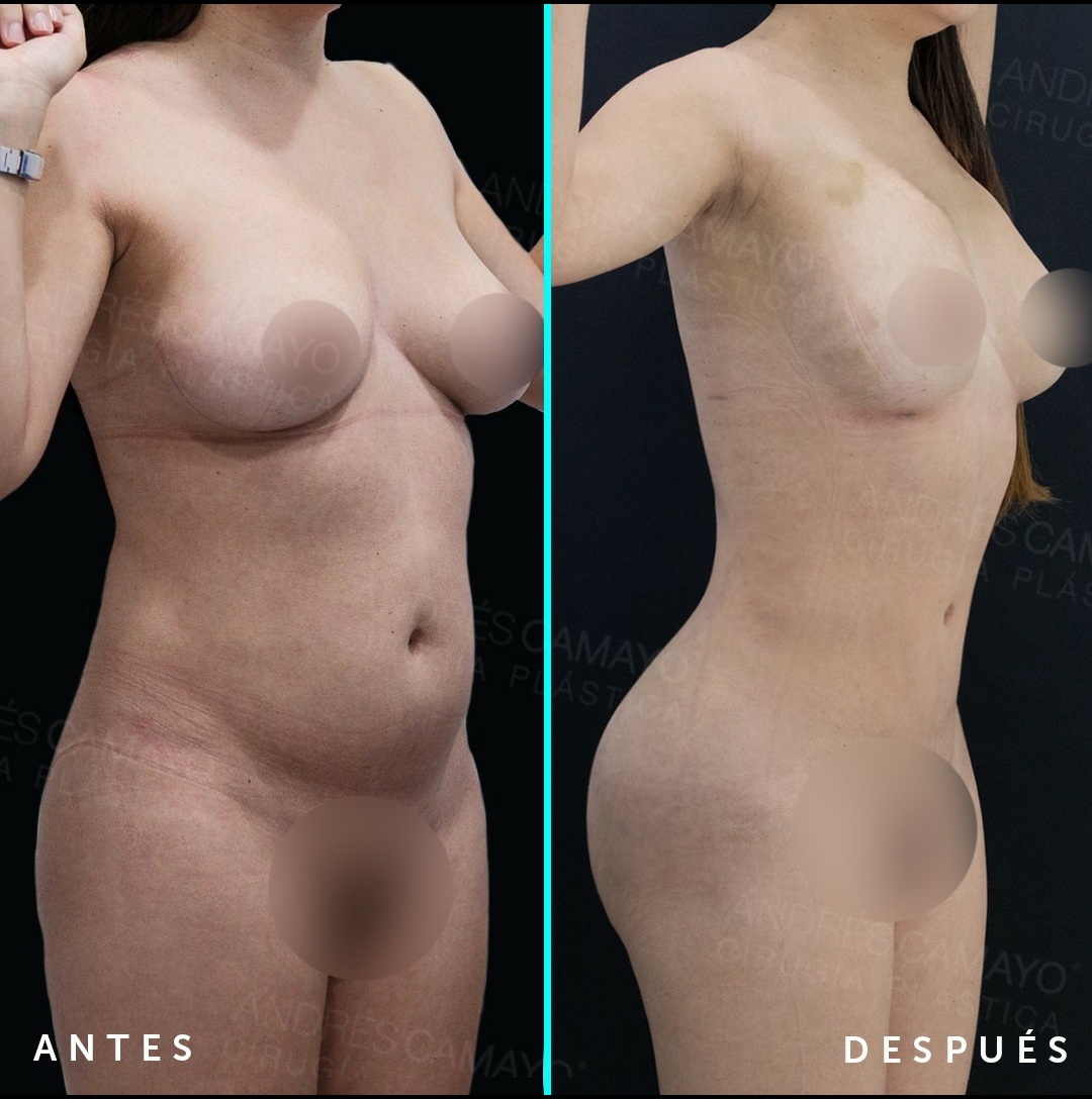 LIPOESCULTURA / MicroAire