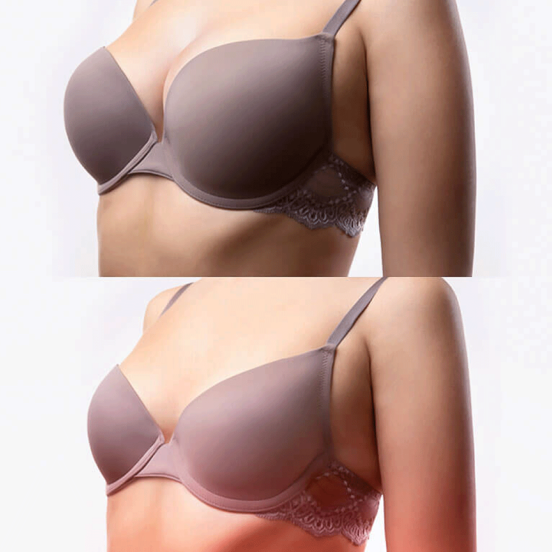 MAMOPLASTIA DE REDUCCIÓN