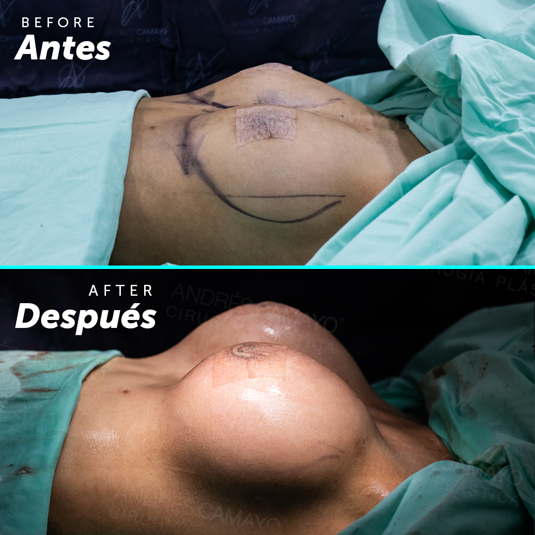 MAMOPLASTIA DE AUMENTO
